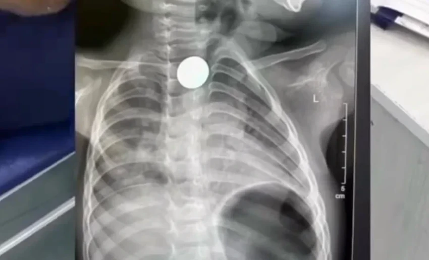 В Бишкеке врачи без операции извлекли монету из пищевода двухлетнего ребенка